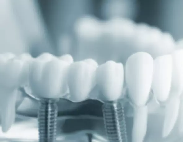 Prüfung von Dentalimplantaten und Dentalmaterialien