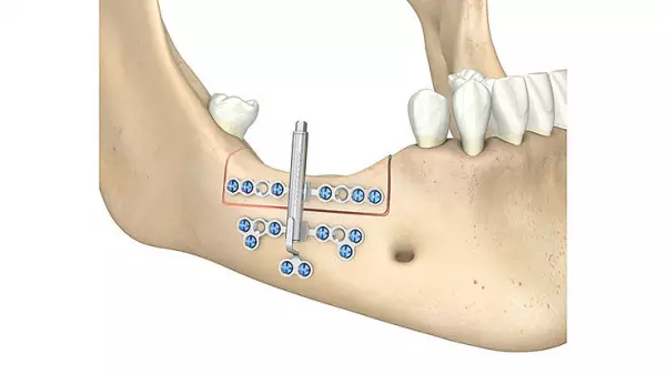 Implantate und Implantatsysteme Dental