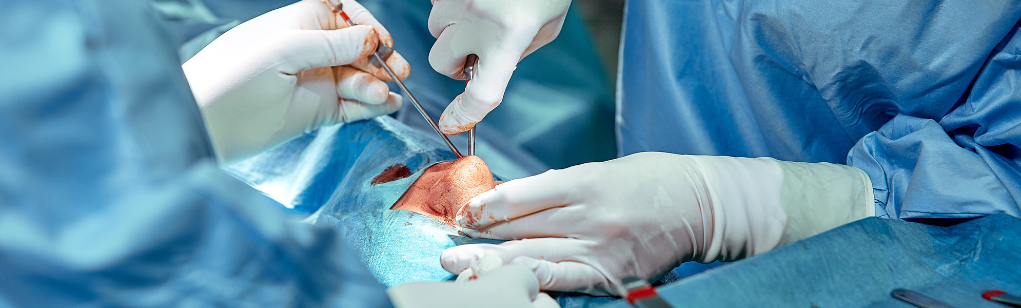 Nasenchirurgie 