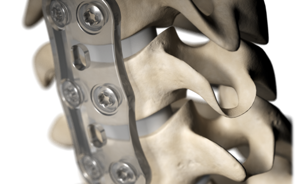 INION S-1 Biodegradable Anterior Cervical Plate